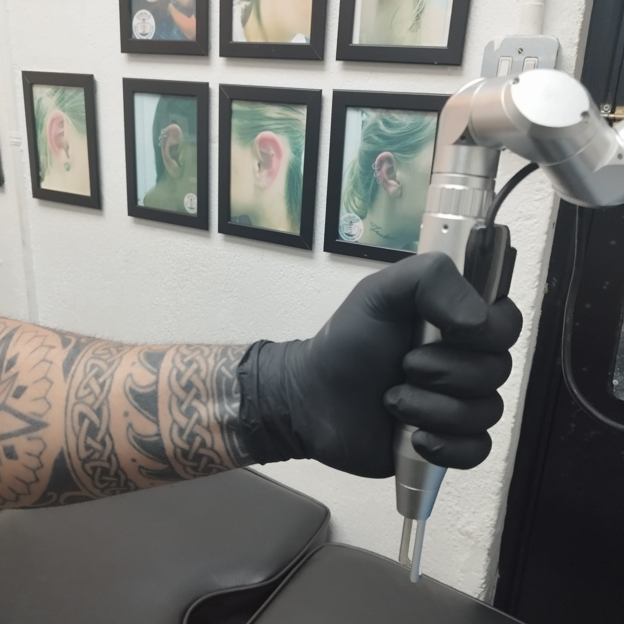 image of laser tattoo removal specialist